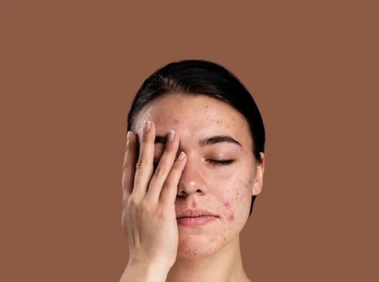 Can Homeopathy Really Treat Acne? What Science and 25 Years of Practice Tell Us