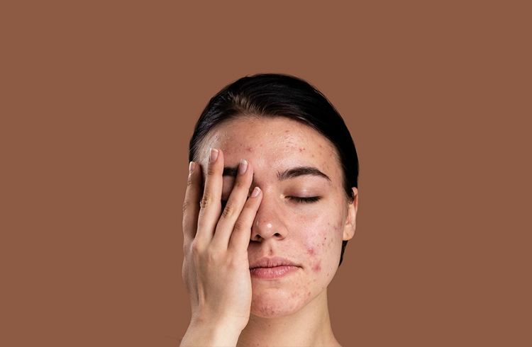 Can Homeopathy Really Treat Acne What Science and 25 Years of Practice Tell Us