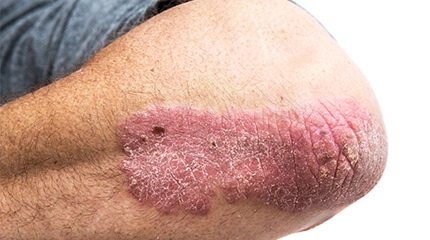Eczema