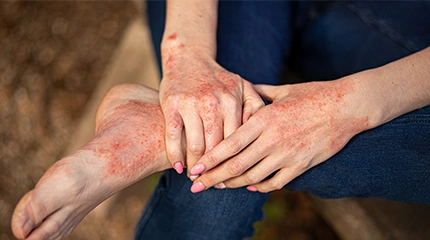 Fungal-Infections