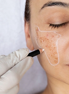 Hyperpigmentation