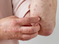 Lichin-Planus-2