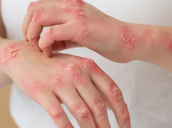 Psoriasis vs Eczema: How to Tell the Difference and Choose the Right Treatment