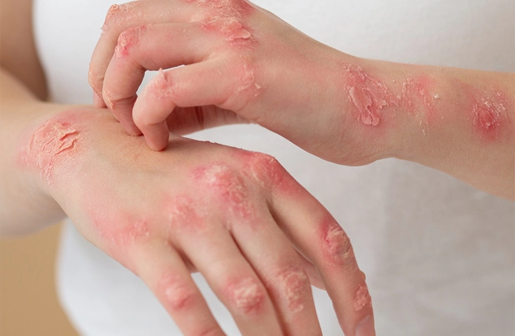 Psoriasis vs Eczema How to Tell the Difference and Choose the Right Treatment